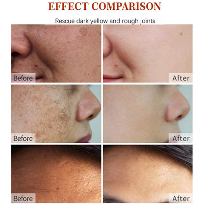 Removedor de manchas oscuras de espinillas de acné de vitamina C facial de cuello vegano natural coreano
